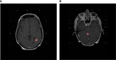 Predicting Adverse Radiation Effects in Brain Tumors After Stereotactic Radiotherapy With Deep Learning and Handcrafted Radiomics